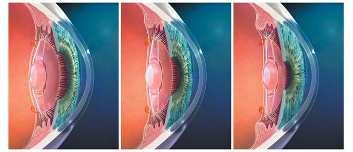 Crystalens accommodating implant lens used in refractive lens exchange.
