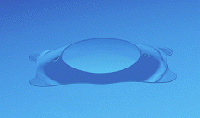 Visian implantable contact lens for correcting high myopia.